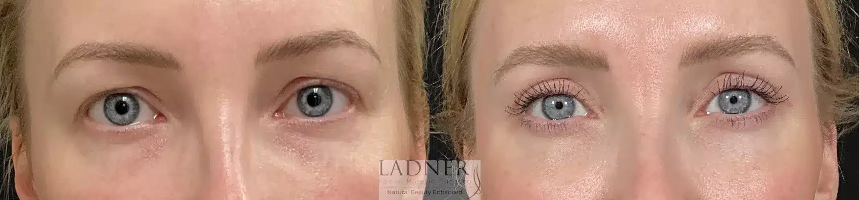Before and After Image: Upper Blepharoplasty - front