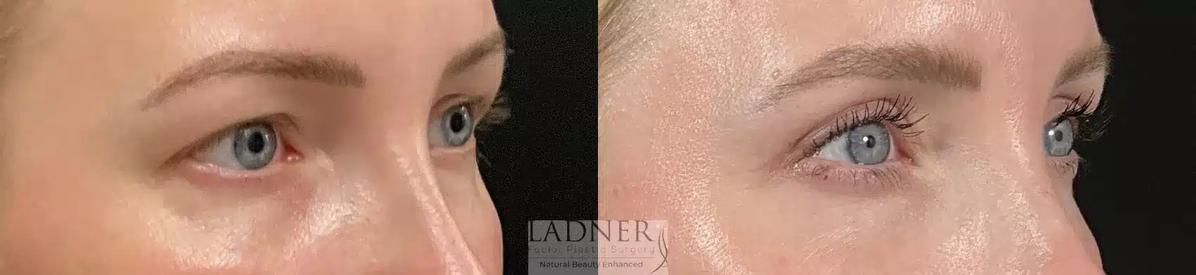 Before and After Image: Upper Blepharoplasty - right-front-oblique