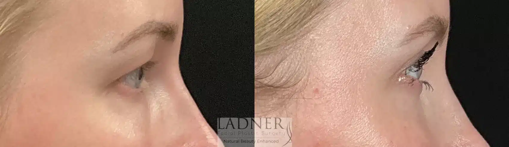 Before and After Image: Upper Blepharoplasty - right-side