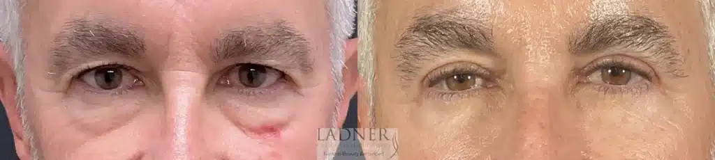 Before and After Image: Upper and Lower Blepharoplasty & Facial Plastic Surgery - front