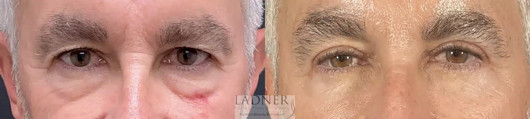 Before and After Image: Upper and Lower Blepharoplasty - front