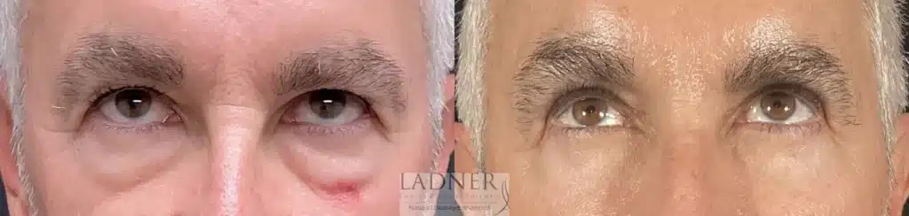 Before and After Image: Upper and Lower Blepharoplasty & Facial Plastic Surgery - front