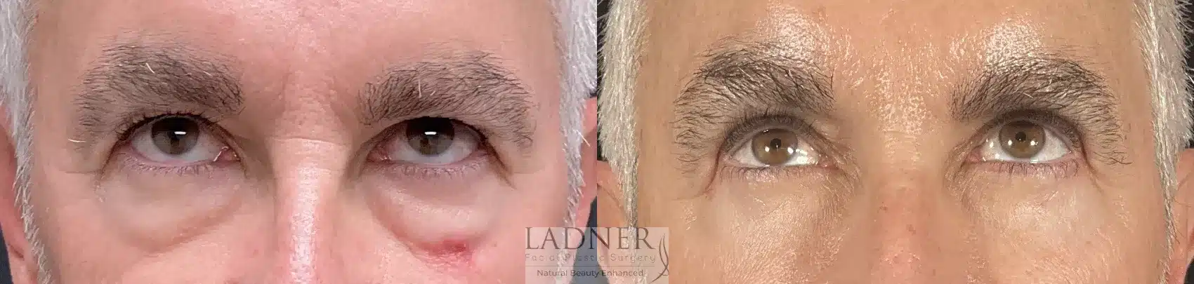 Before and After Image: Upper and Lower Blepharoplasty - front