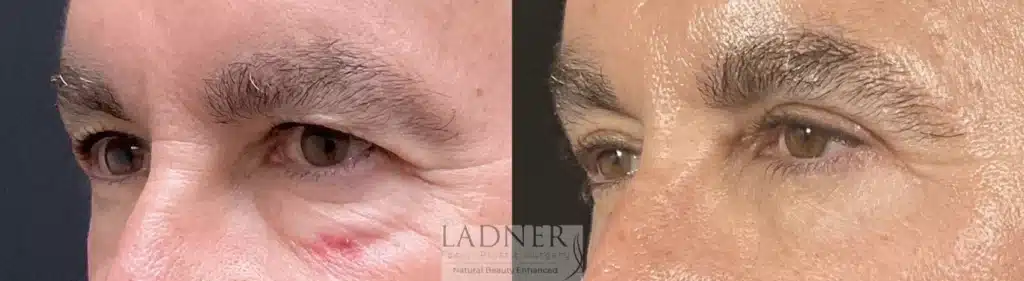 Before and After Image: Upper and Lower Blepharoplasty & Facial Plastic Surgery - left-front-oblique
