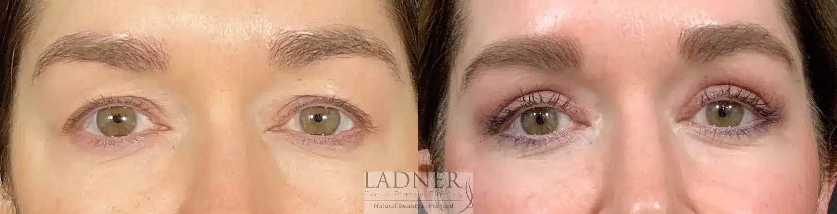 Before and After Image: Blepharoplasty - front