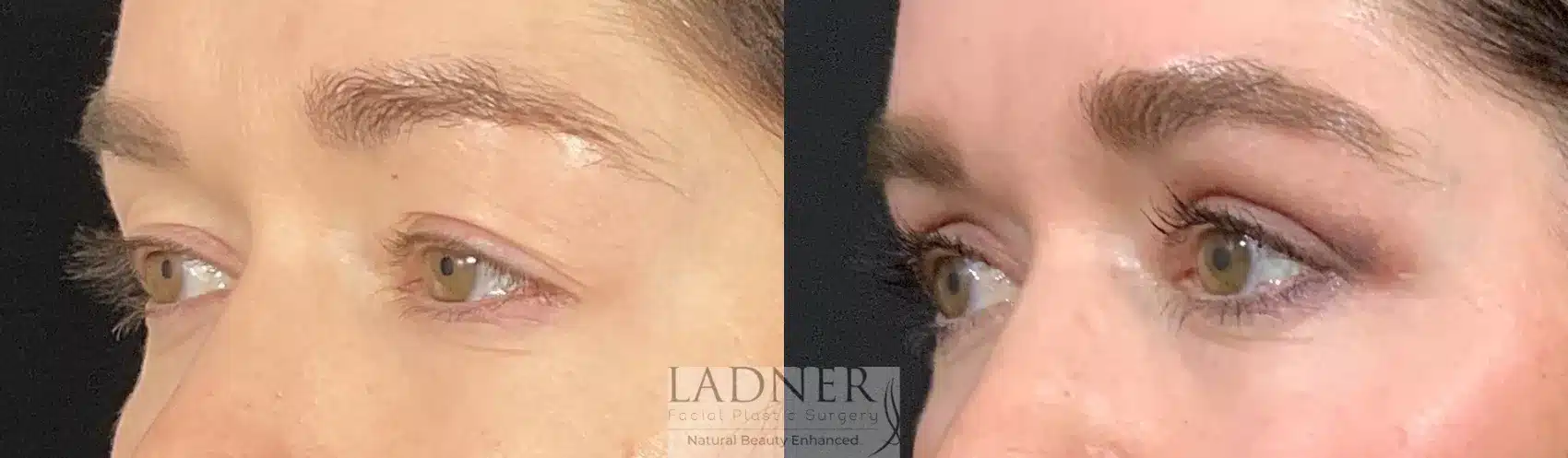 Before and After Image: Blepharoplasty - left-front-oblique