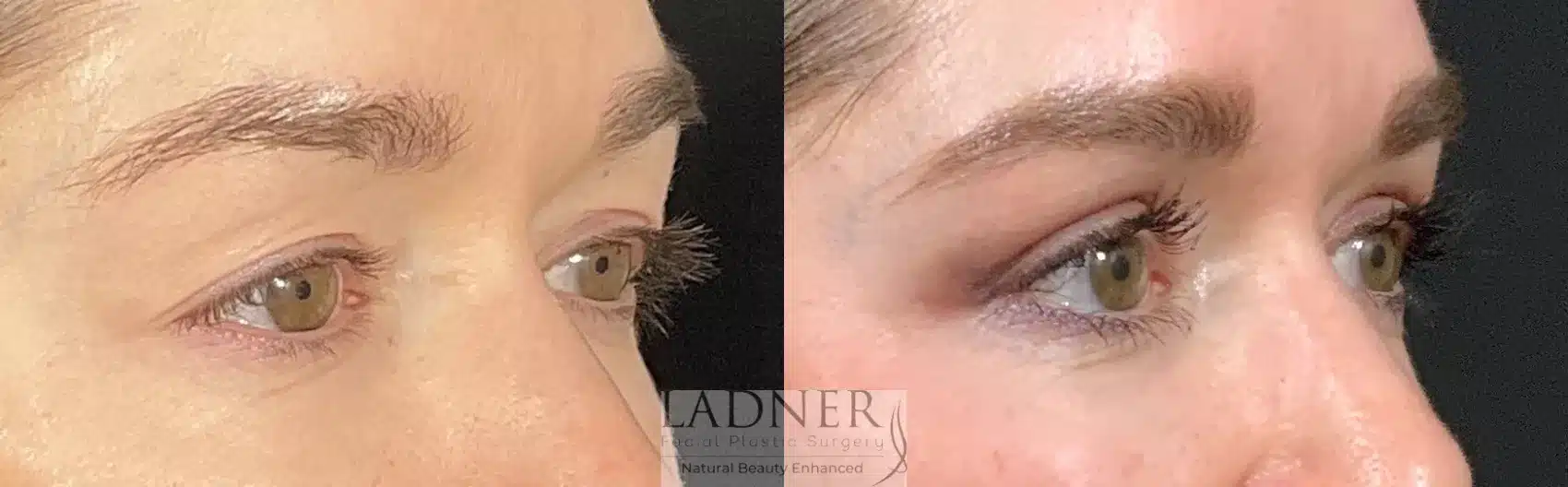 Before and After Image: Blepharoplasty - right-front-oblique