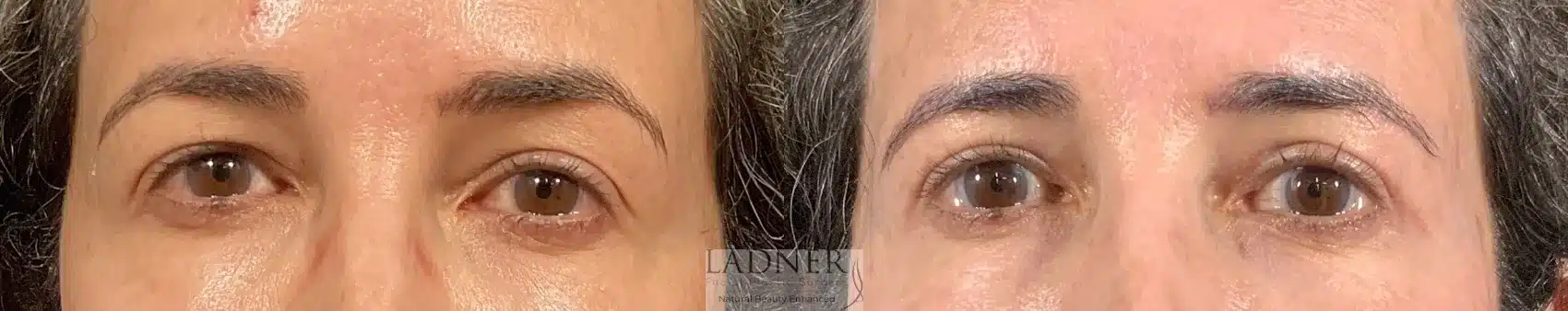 Before and After Image: Blepharoplasty - front