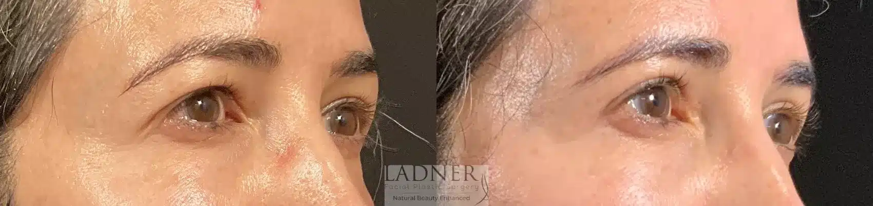 Before and After Image: Blepharoplasty - right-front-oblique