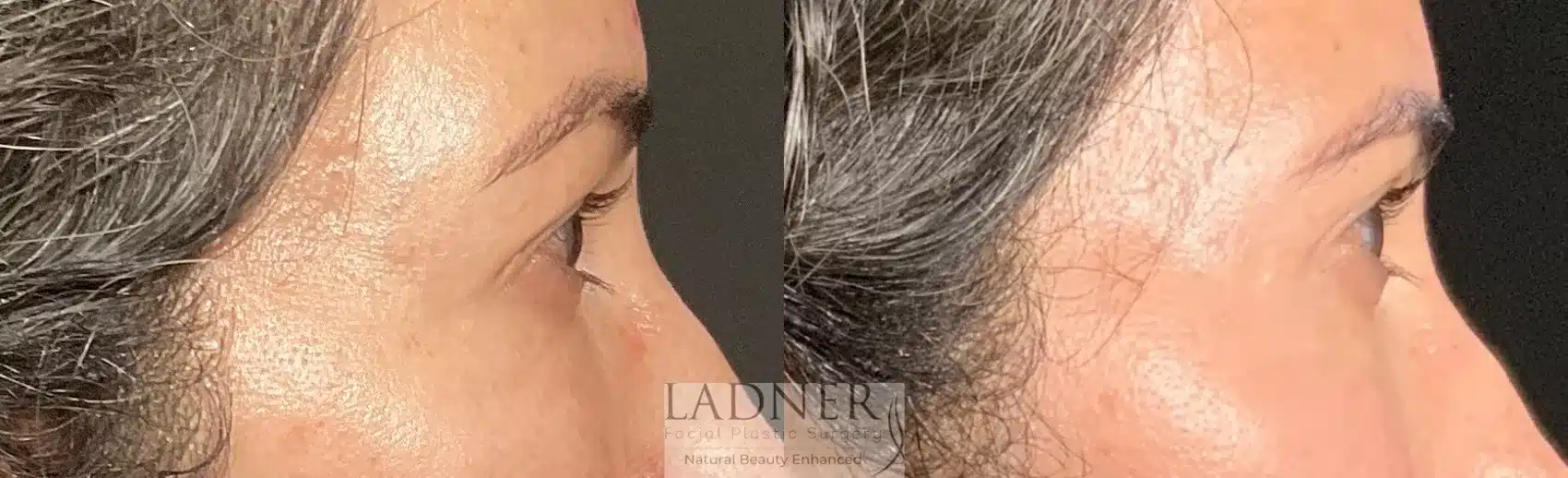 Before and After Image: Blepharoplasty - right-side