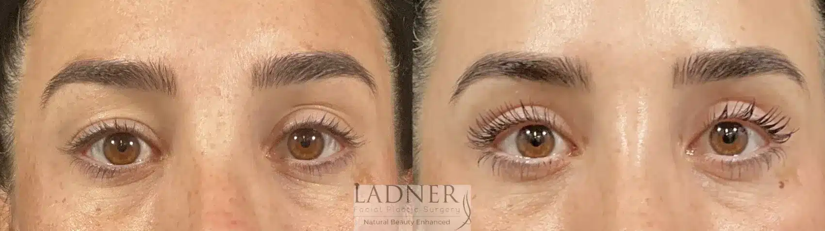 Before and After Image: Upper Blepharoplasty - front