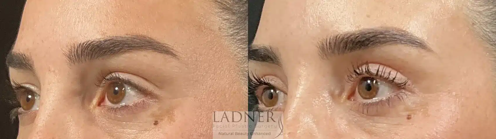 Before and After Image: Upper Blepharoplasty - left-front-oblique