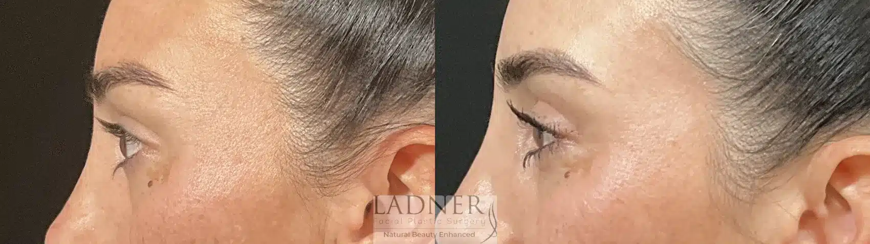 Before and After Image: Upper Blepharoplasty - left-side