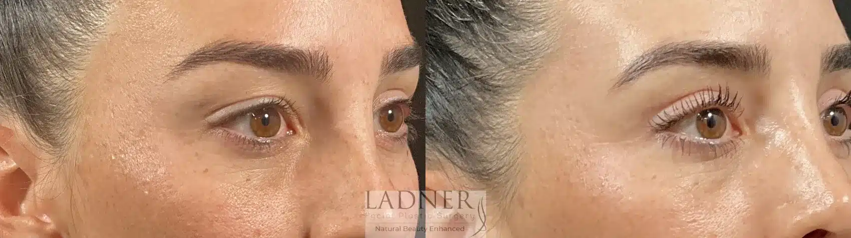 Before and After Image: Upper Blepharoplasty - right-front-oblique