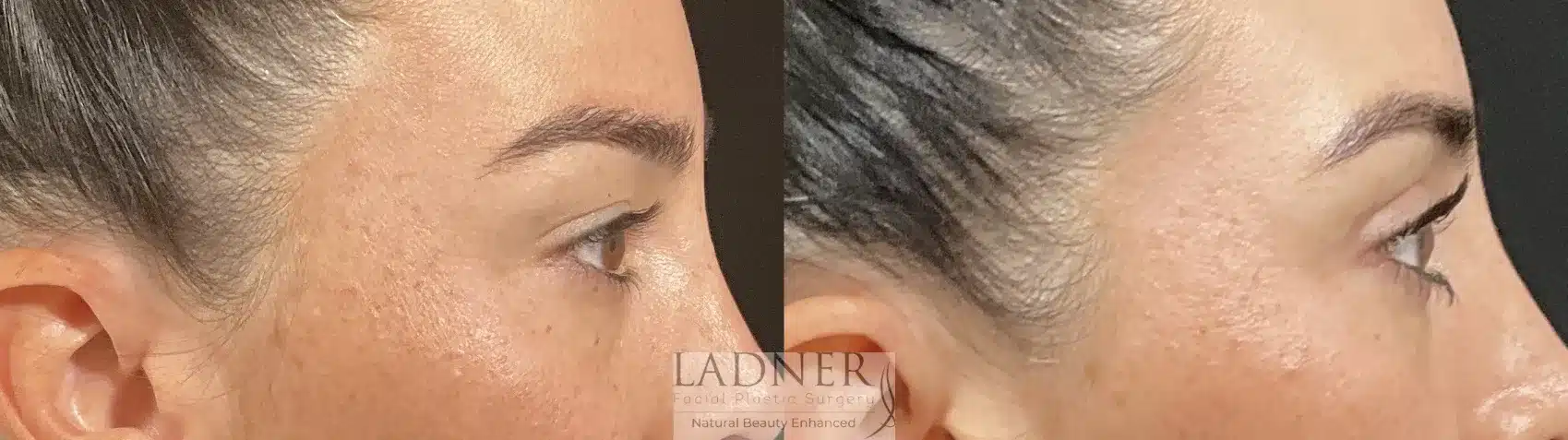 Before and After Image: Upper Blepharoplasty - right-side