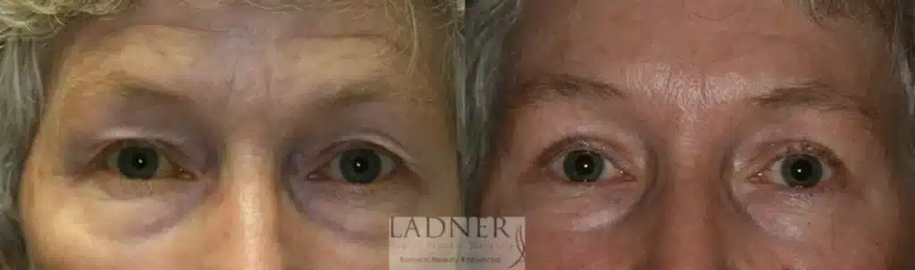 Before and After Image: Upper Blepharoplasty & Brow Lift/Forehead Lift - front