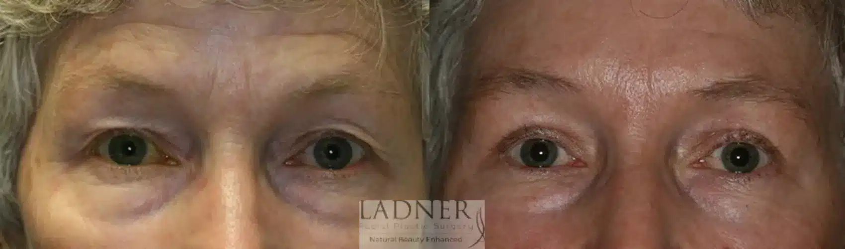Before and After Image: Upper Blepharoplasty - front