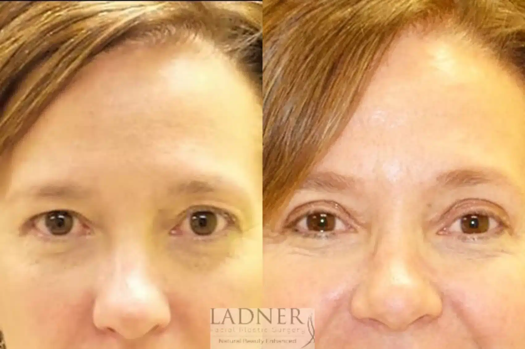 Before and After Image: Upper Blepharoplasty - front