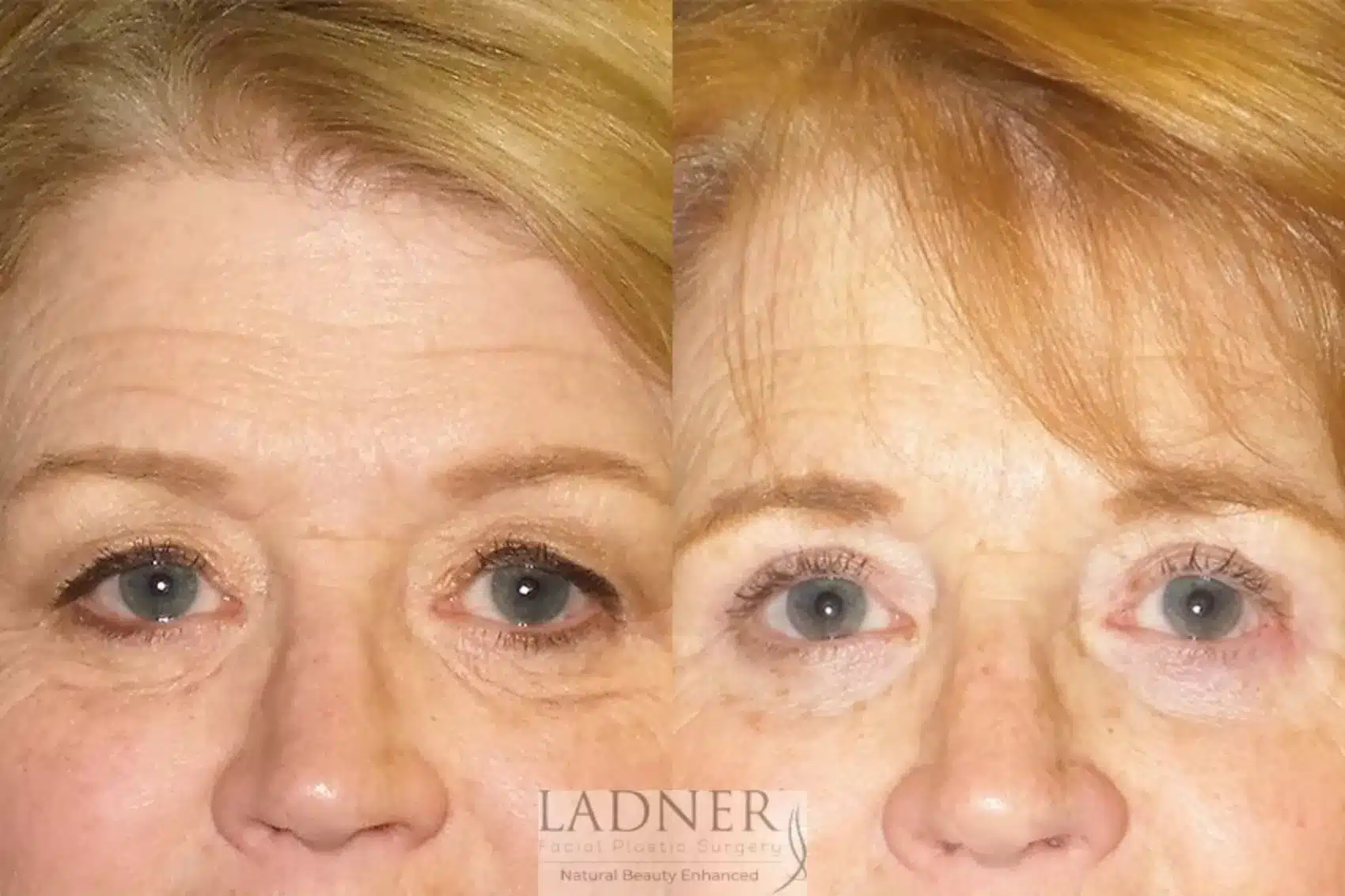 Before and After Image: Upper and Lower Blepharoplasty - front