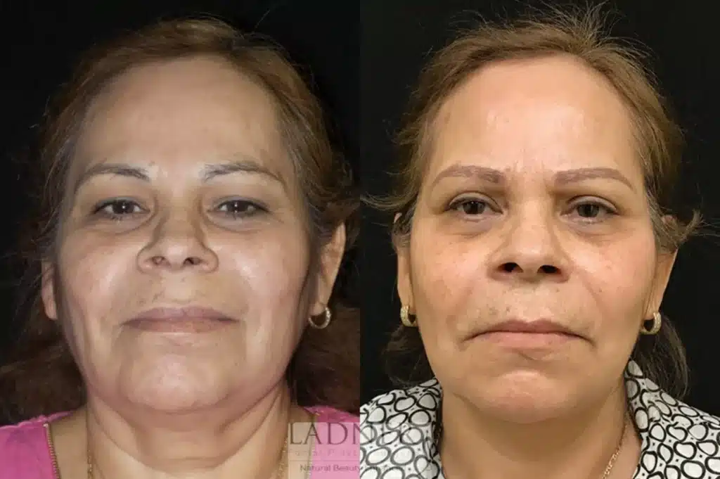 Before and After Image: Lower Deep Plane Facelift/Neck Lift & Blepharoplasty - front
