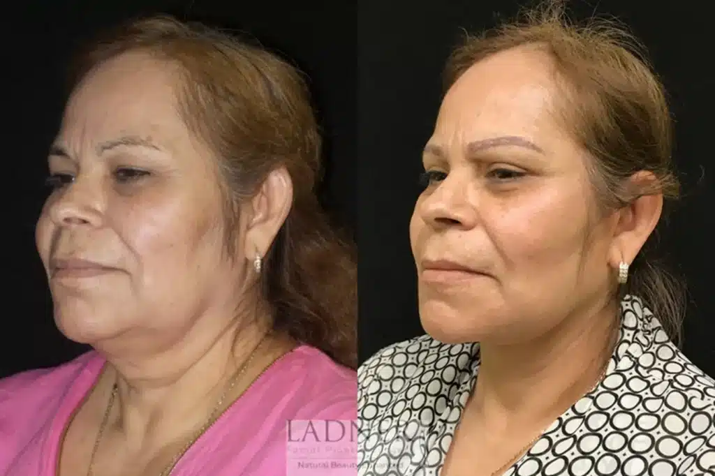Before and After Image: Lower Deep Plane Facelift/Neck Lift & Blepharoplasty - left-front-oblique