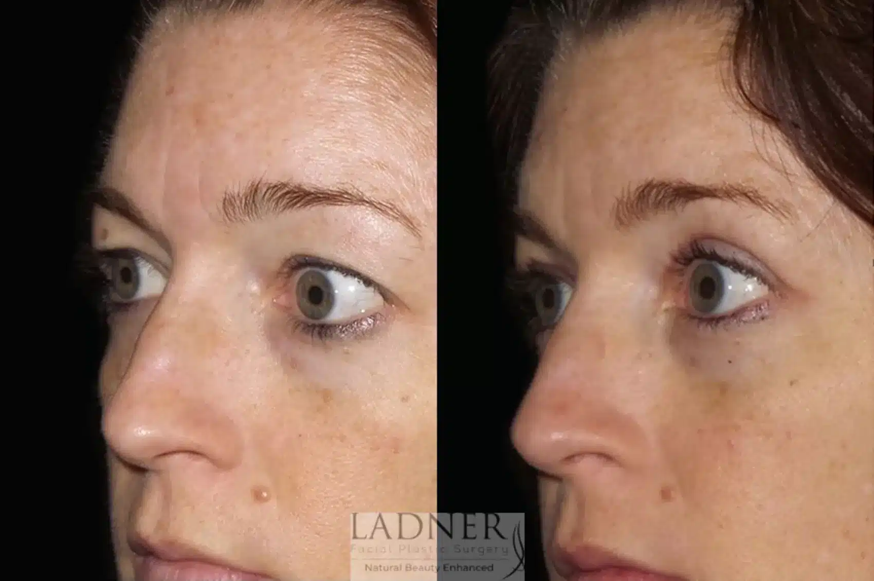 Before and After Image: Upper Blepharoplasty - left-front-oblique