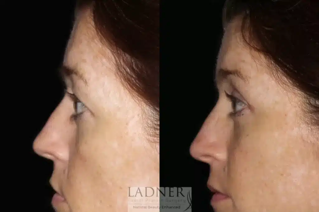 Before and After Image: Upper Blepharoplasty - left-side