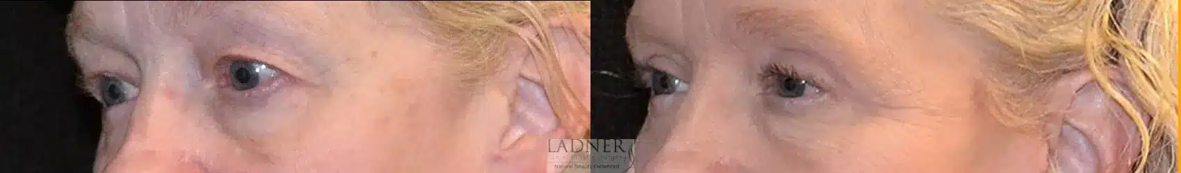 Before and After Image: Upper Blepharoplasty - left-front-oblique