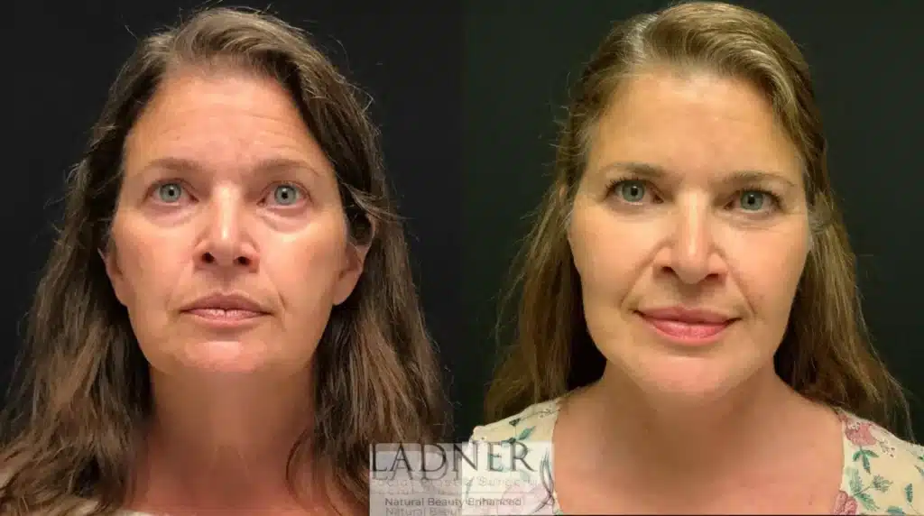 Before and After Image: Deep Plane Facelift/Neck Lift & Lower Blepharoplasty - front