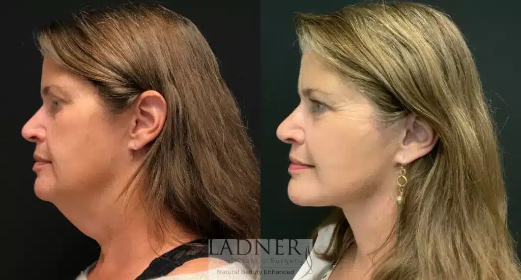 Before and After Image: Deep Plane Facelift/Neck Lift & Lower Blepharoplasty - left-side