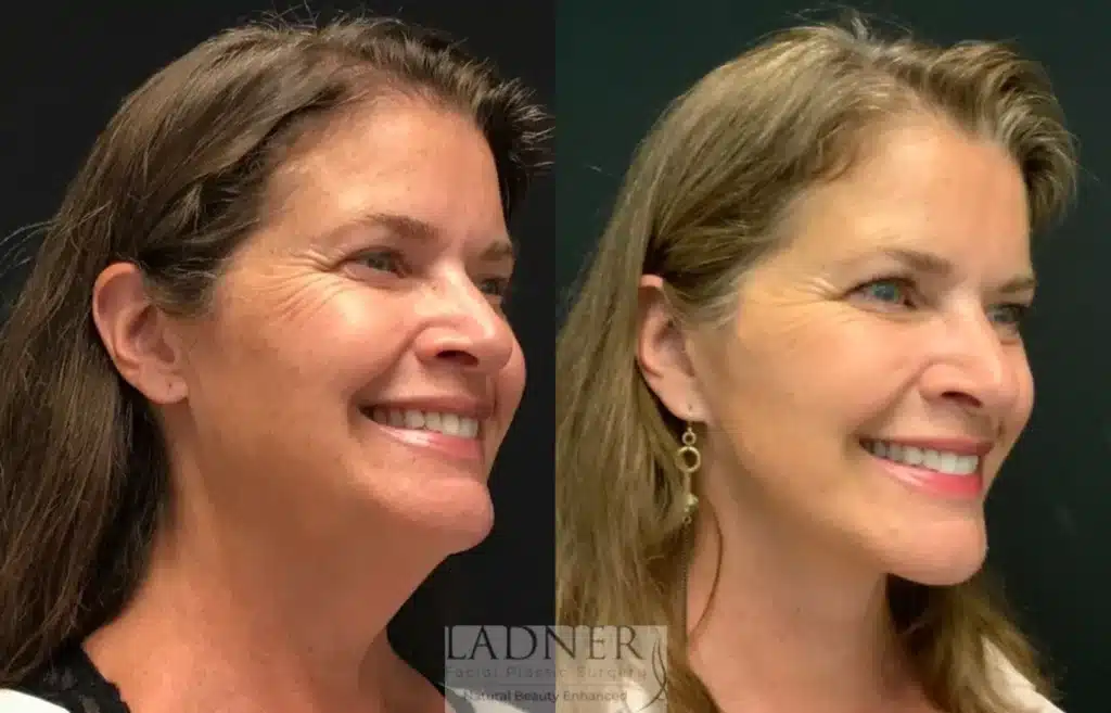 Before and After Image: Deep Plane Facelift/Neck Lift & Lower Blepharoplasty - right-front-oblique