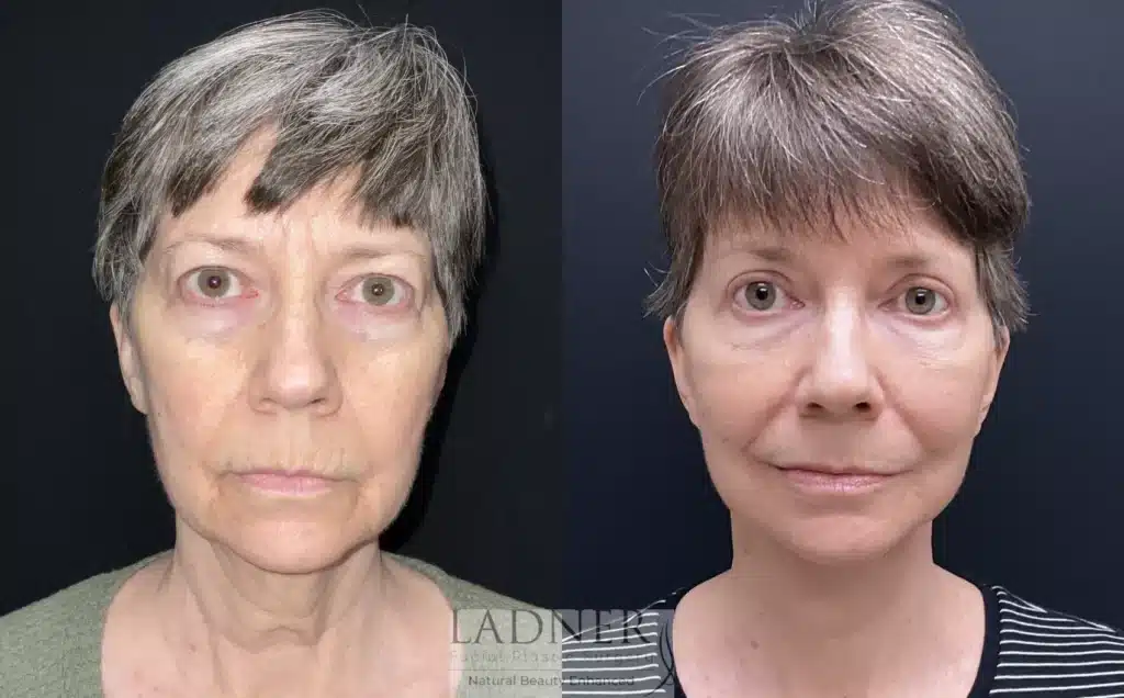 Before and After Image: Lower Deep Plane Facelift, Blepharoplasty, Brow Lift/Forehead Lift, & Facial Fat Transfer - front