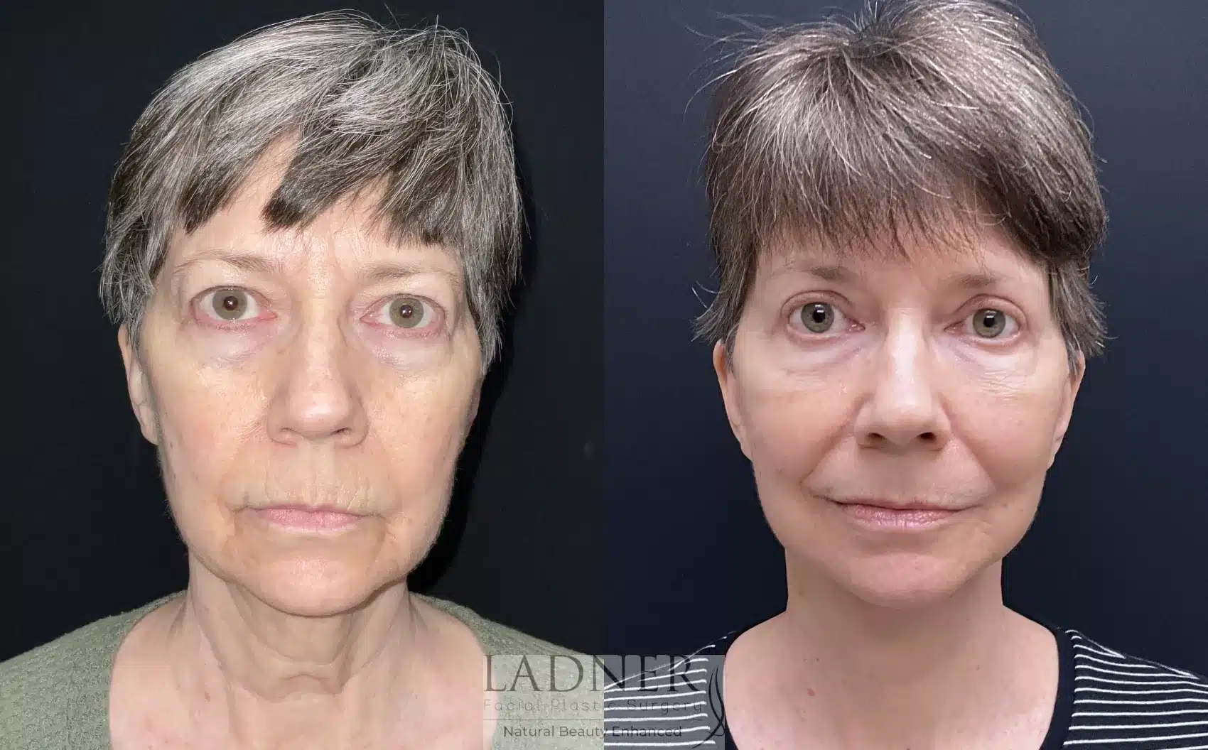 Before and After Image: Lower Deep Plane Facelift - front