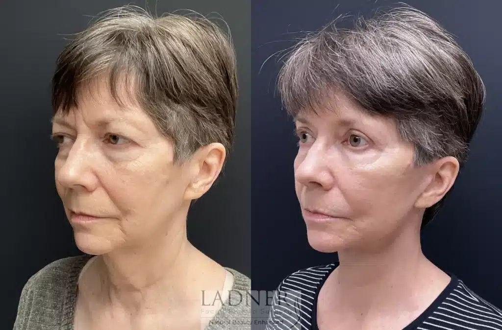 Before and After Image: Lower Deep Plane Facelift, Blepharoplasty, Brow Lift/Forehead Lift, & Facial Fat Transfer - left-front-oblique