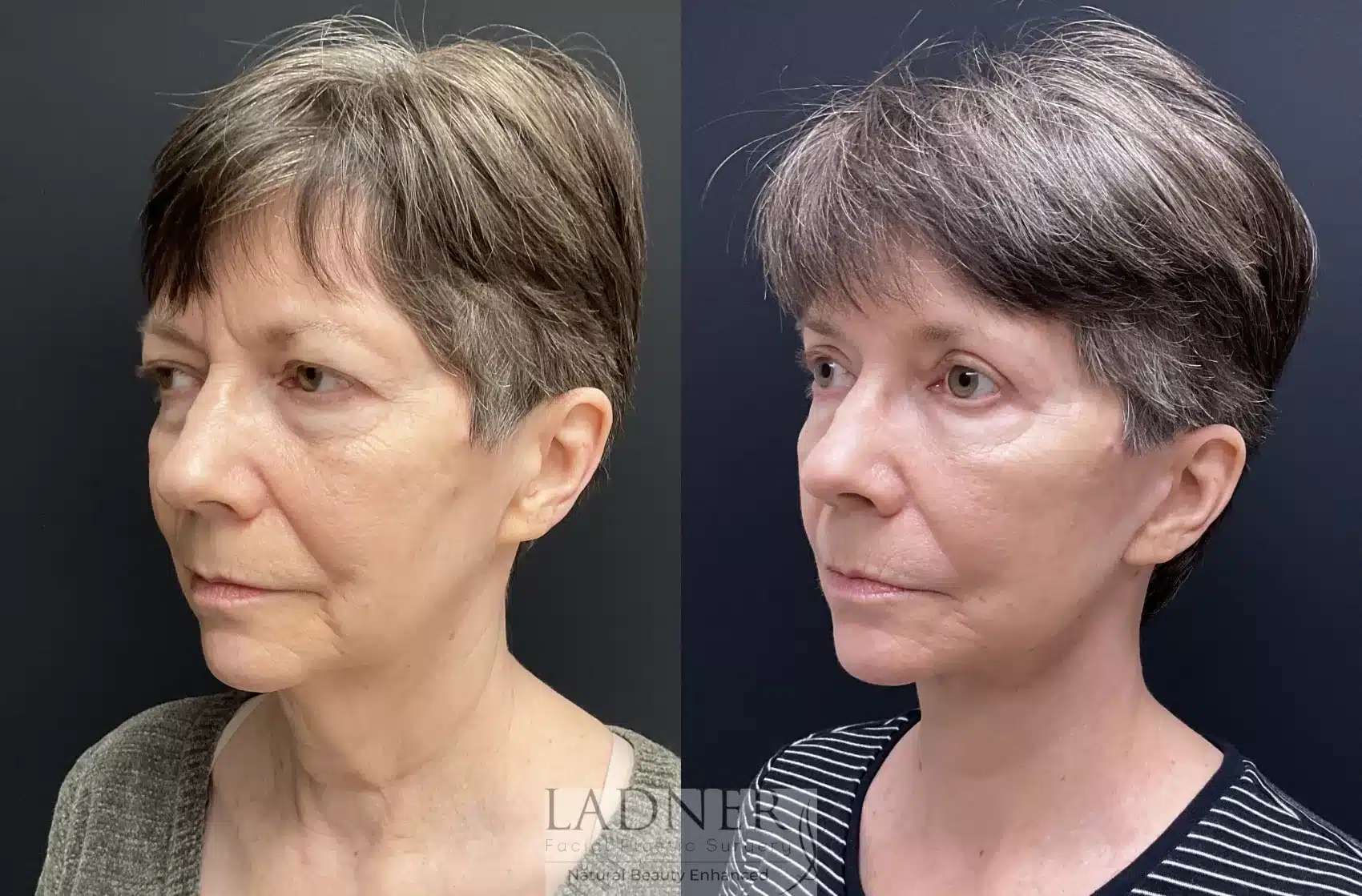 Before and After Image: Lower Deep Plane Facelift - left-front-oblique