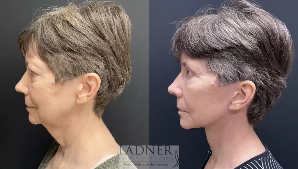 Before and After Image: Lower Deep Plane Facelift, Blepharoplasty, Brow Lift/Forehead Lift, & Facial Fat Transfer - left-side