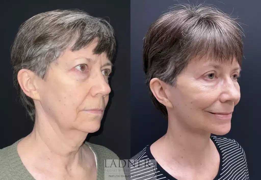 Before and After Image: Lower Deep Plane Facelift, Blepharoplasty, Brow Lift/Forehead Lift, & Facial Fat Transfer - right-front-oblique