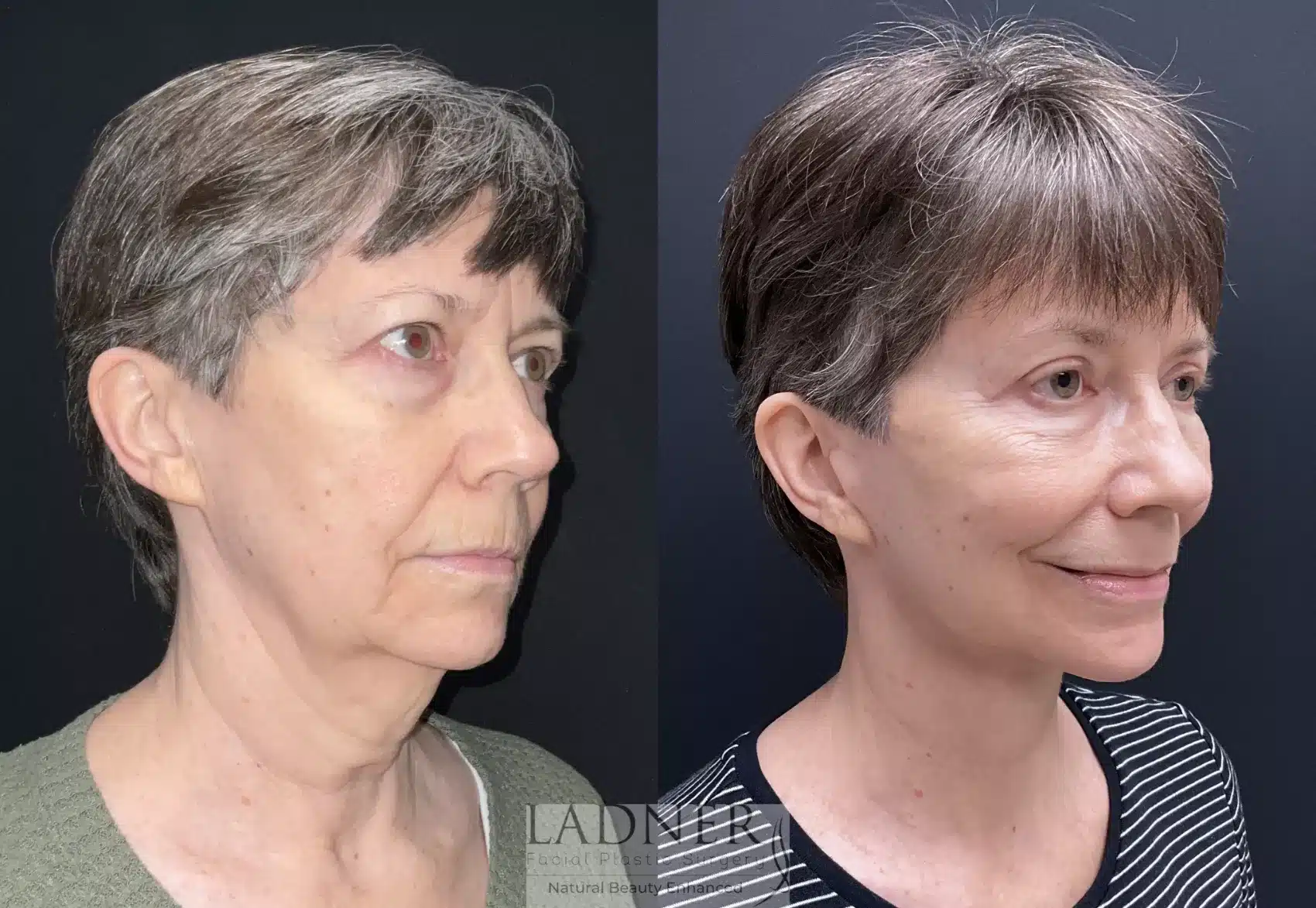 Before and After Image: Lower Deep Plane Facelift - right-front-oblique