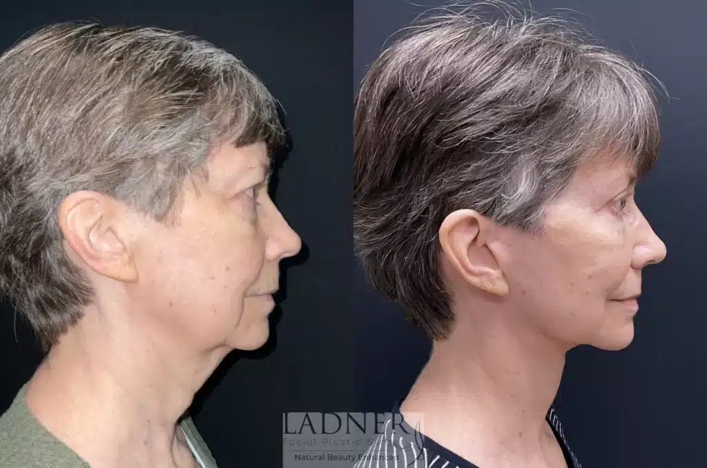 Before and After Image: Lower Deep Plane Facelift, Blepharoplasty, Brow Lift/Forehead Lift, & Facial Fat Transfer - right-side