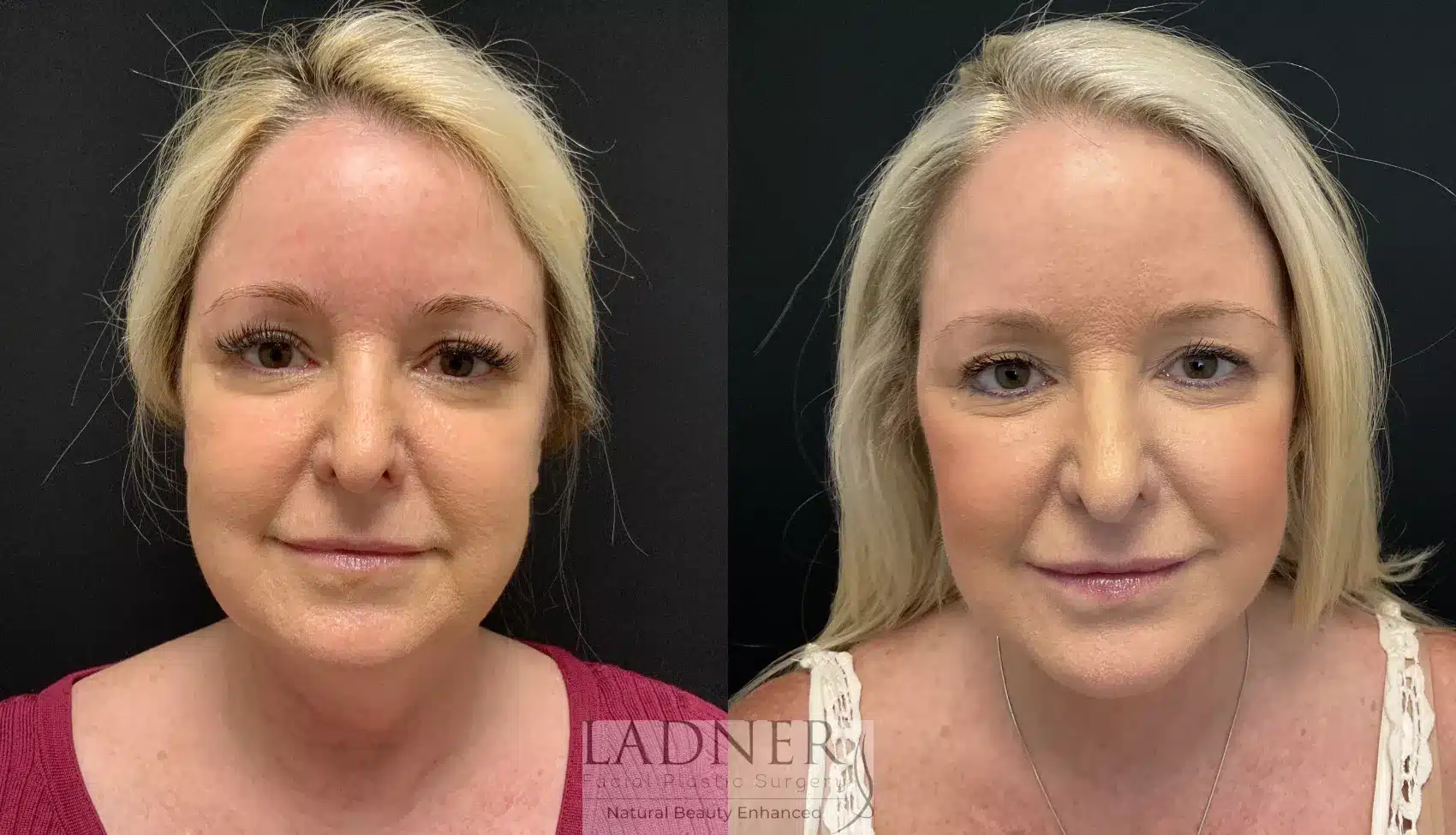 Before and After Image: Lower Deep Plane Facelift - front