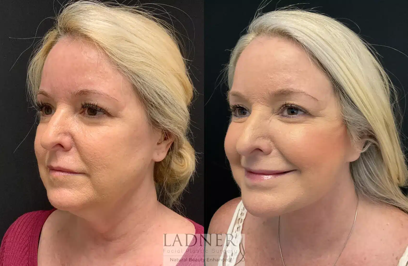 Before and After Image: Lower Deep Plane Facelift - left-front-oblique