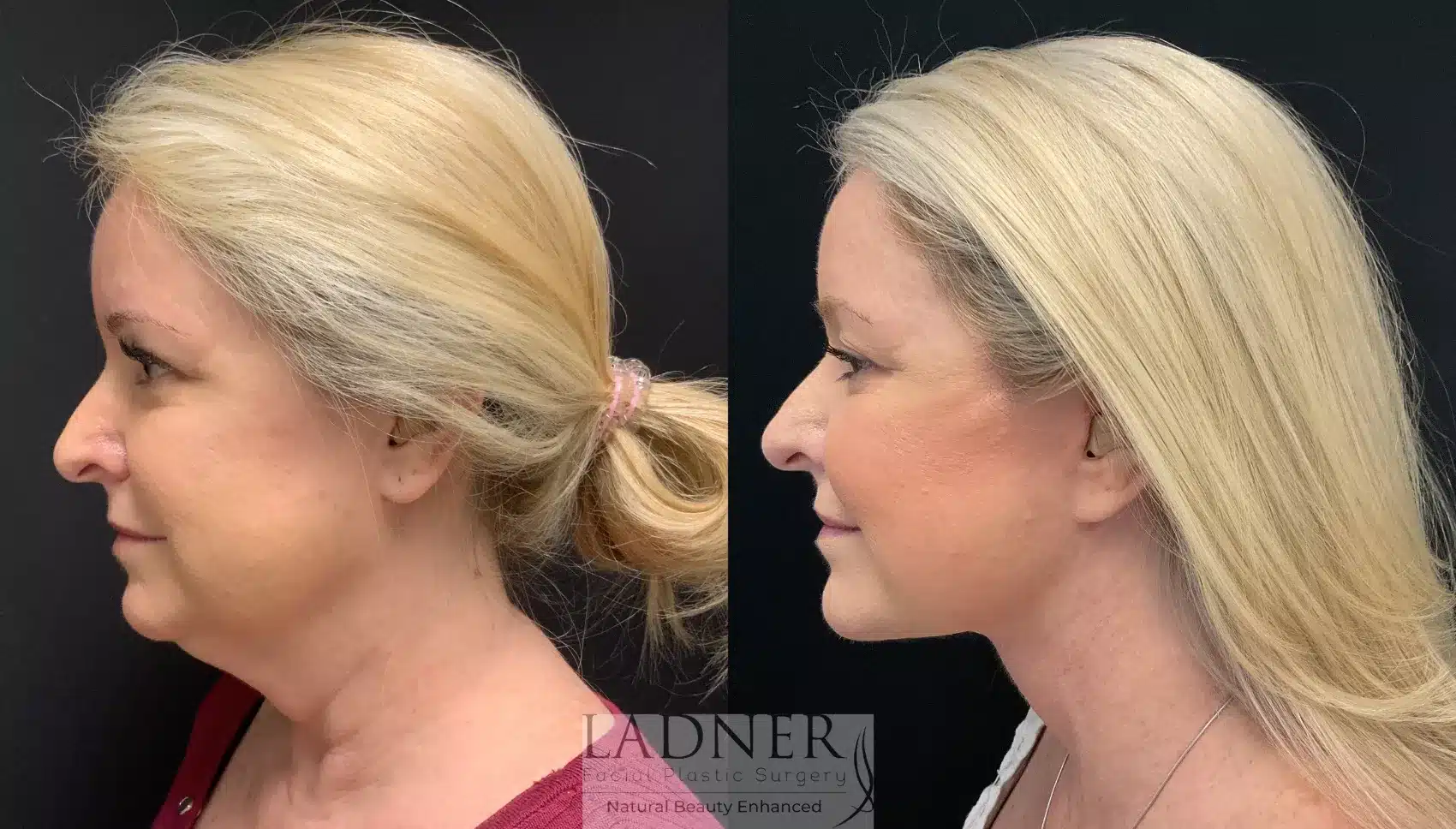 Before and After Image: Lower Deep Plane Facelift - left-side