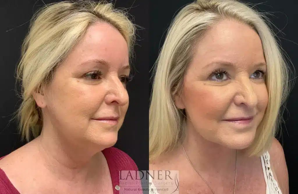 Before and After Image: Lower Deep Plane Facelift - right-front-oblique