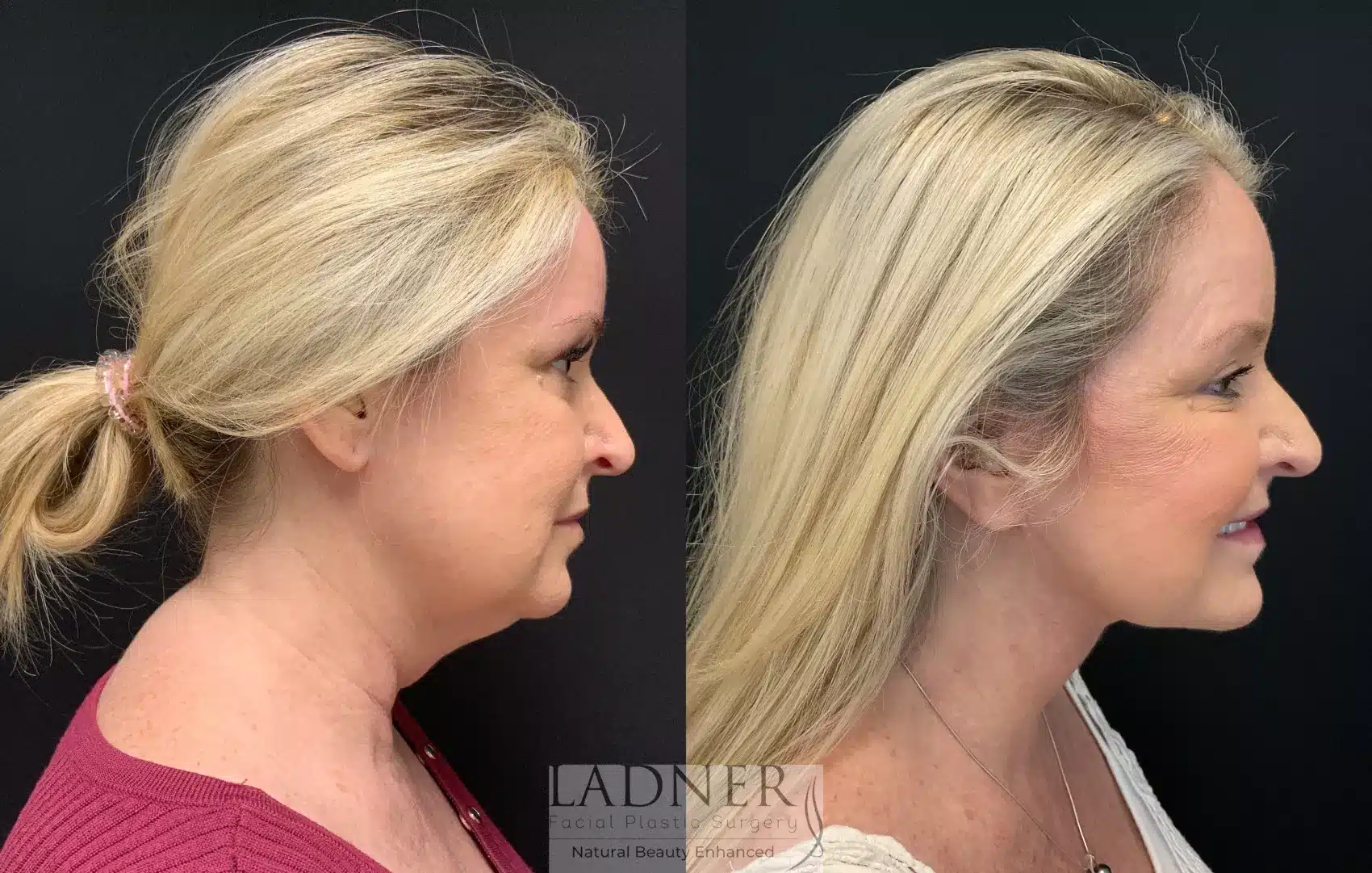 Before and After Image: Lower Deep Plane Facelift - right-side
