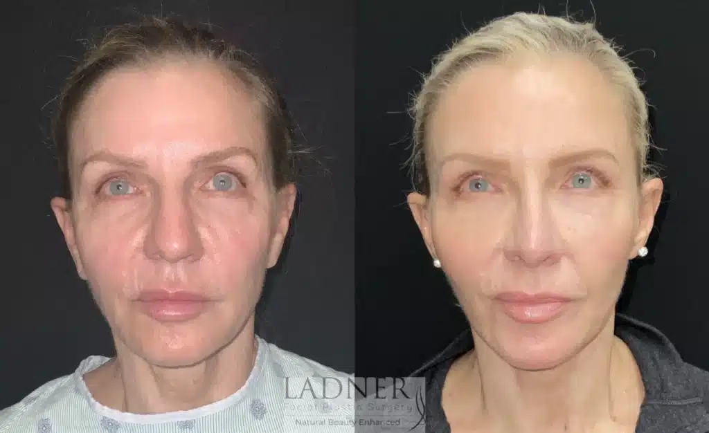 Before and After Image: Deep Plane Facelift/Neck Lift & Facial Fat Transfer - front