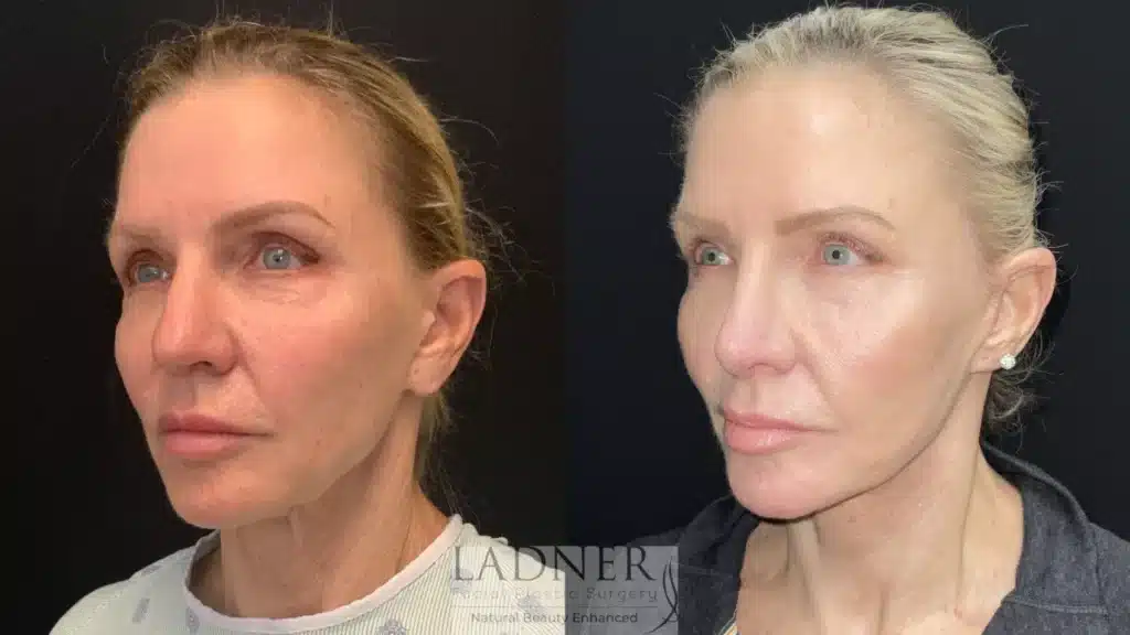 Before and After Image: Deep Plane Facelift/Neck Lift & Facial Fat Transfer - left-front-oblique