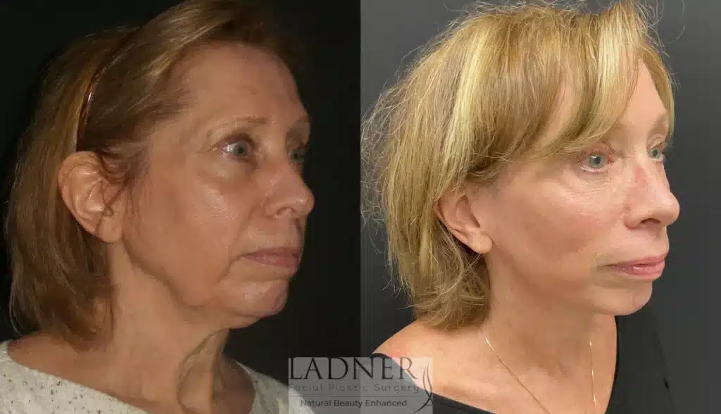 Before and After Image: Deep Plane Facelift/Neck Lift, Blepharoplasty, and Brow Lift/Forehead Lift - right-front-oblique