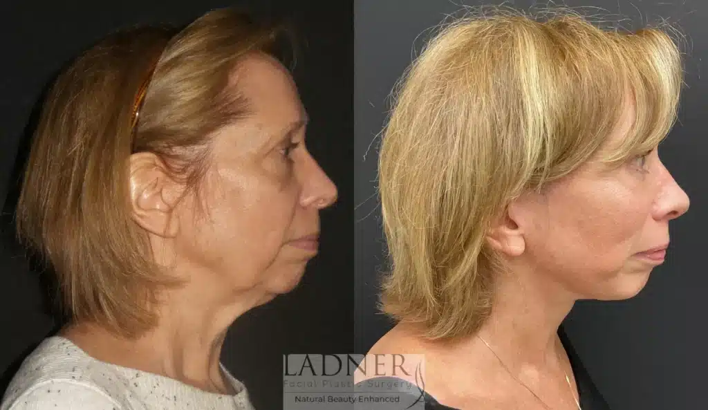 Before and After Image: Deep Plane Facelift/Neck Lift, Blepharoplasty, and Brow Lift/Forehead Lift - right-side
