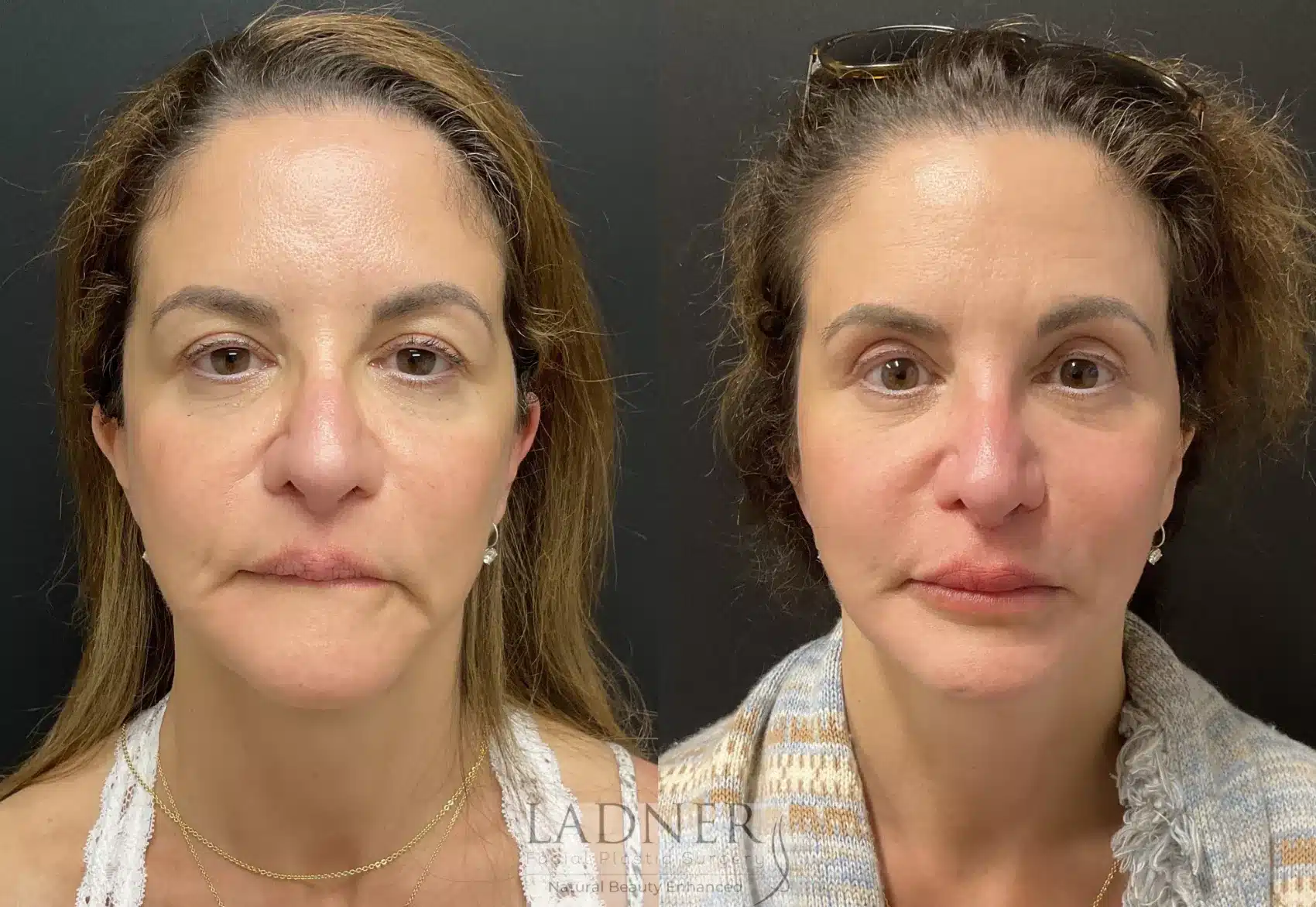 Before and After Image: Deep Plane Facelift/Neck Lift - front