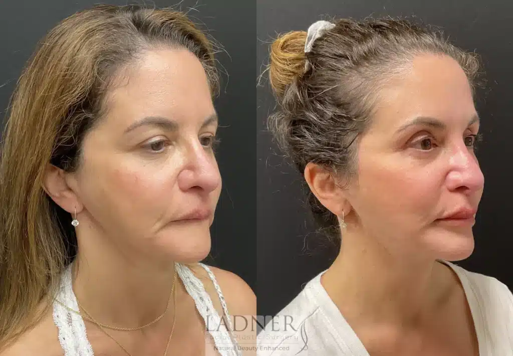 Before and After Image: Deep Plane Facelift/Neck Lift, Blepharoplasty, and Facial Fat Transfer - right-front-oblique